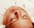 Curso completo de acupuntura